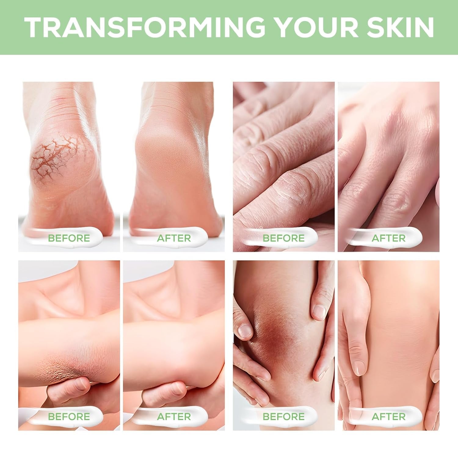 Urea-Fußcreme, Urea-Creme 40 Prozent Für Die Füße, Mit Hyaluronsäure, Teebaum Und Aloe Vera, Fersenbalsam Zur Hornhautentfernung Und Erweichung, Für Trockene, Rissige Füße, Fersen Und Hände (120 G)